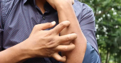 Studio Novartis, l’orticaria cronica spontanea costa 4.200 euro l’anno a paziente