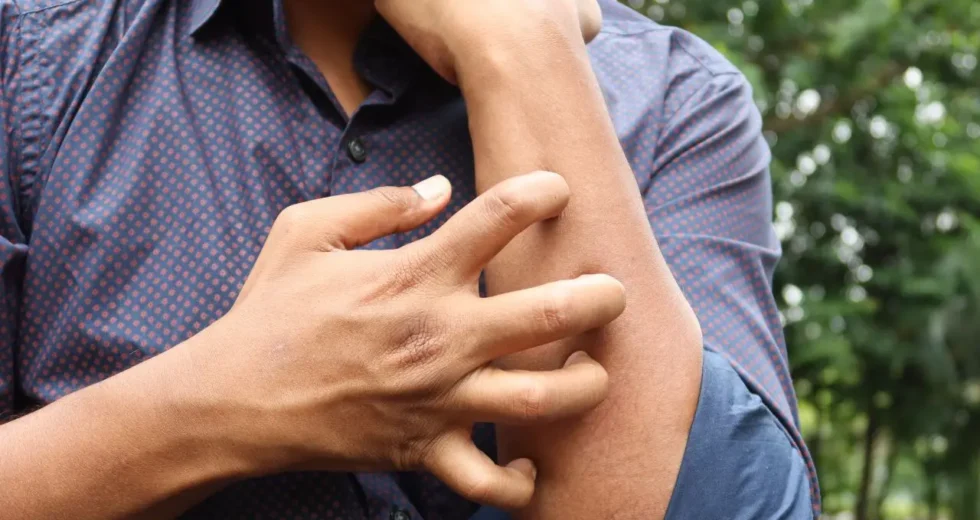 Studio Novartis, l’orticaria cronica spontanea costa 4.200 euro l’anno a paziente